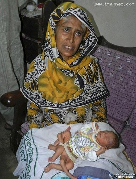 تولد عجیب و باورنکردنی نوزاد 6 پا در پاکستان! +عکس 