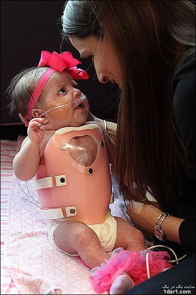 نوزاد دختری که با قلب بیرون از سینه متولد شد