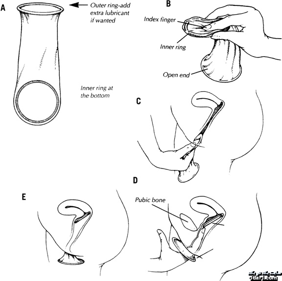 آموزش استفاده از کاندوم زنانه